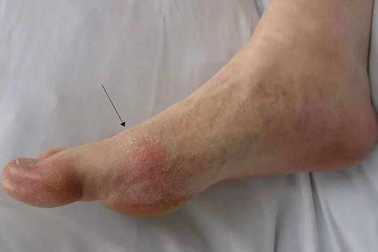 类风湿关节炎脚趾关节肿痛图 类风湿关节炎脚趾关节肿痛图