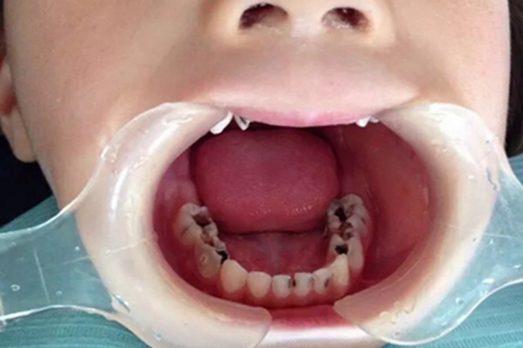 低龄儿童龋下牙有坑图