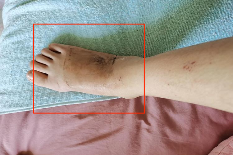 右足第二跖骨骨折脚背肿胀图