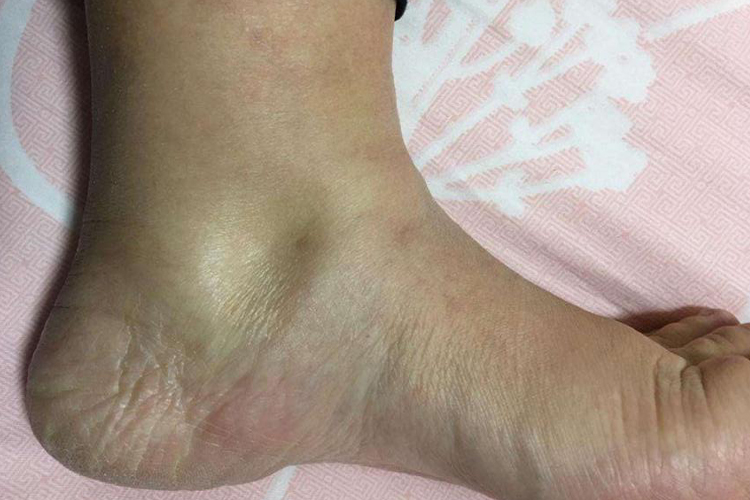 慢性肾小球肾炎脚脖子肿图<br />
