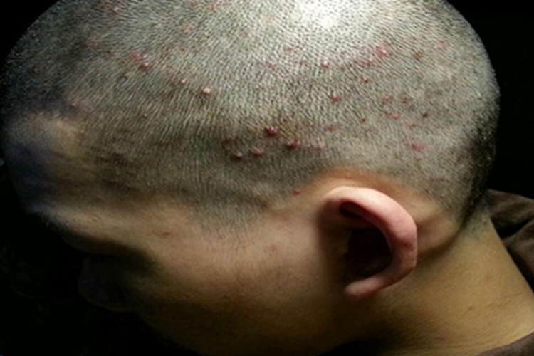 毛囊炎长硬包图片