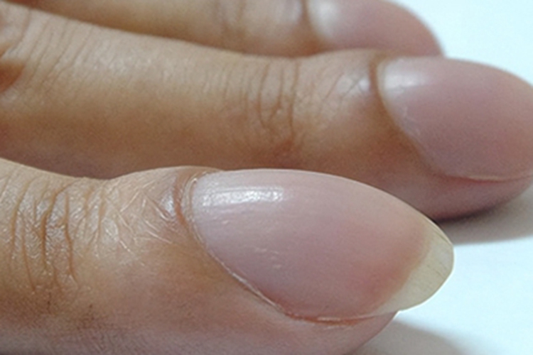 肥大性骨关节病杵状指图 肥大性骨关节病杵状指图