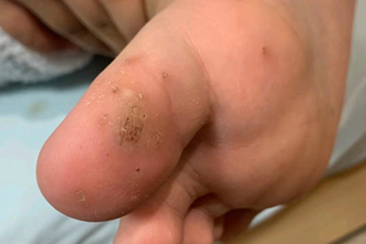 寻常疣脚底有黄褐色硬结图 寻常疣脚底有黄褐色硬结图