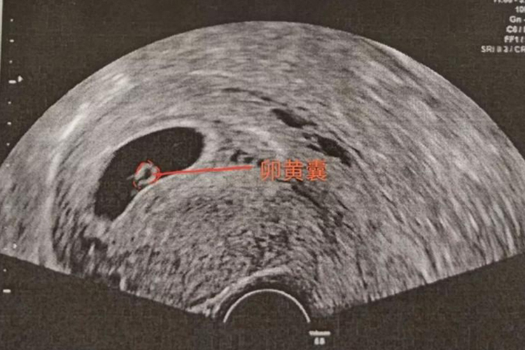 15天的胚胎超声影像图