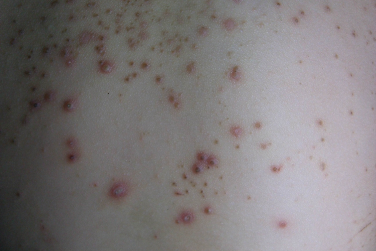 马拉色菌毛囊炎干瘪结痂图