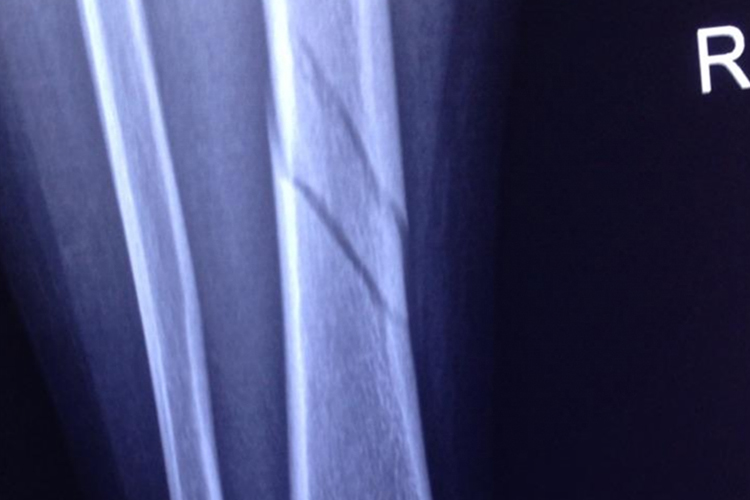 小腿胫骨骨折X线图