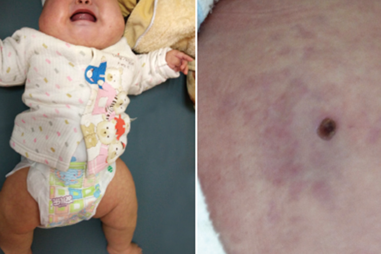 先天性甲状腺功能低下婴儿四肢短小图