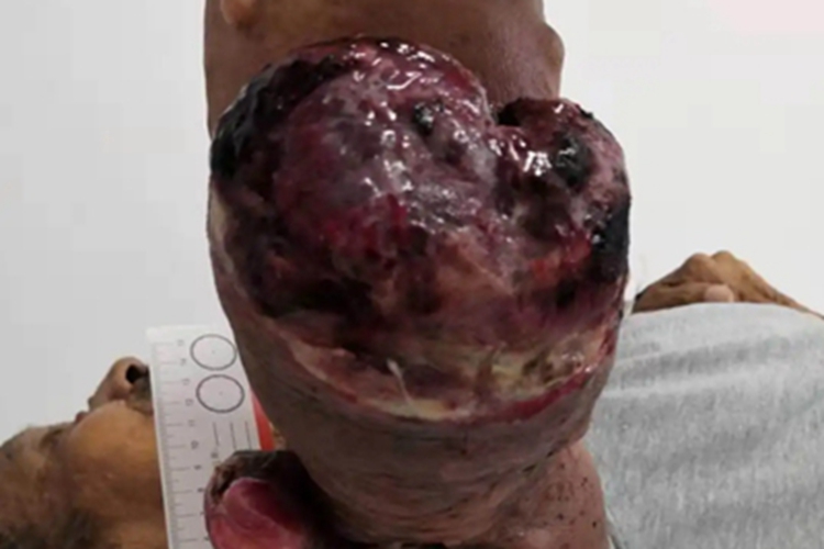 进行性结节性组织细胞瘤包块图 进行性结节性组织细胞瘤包块图