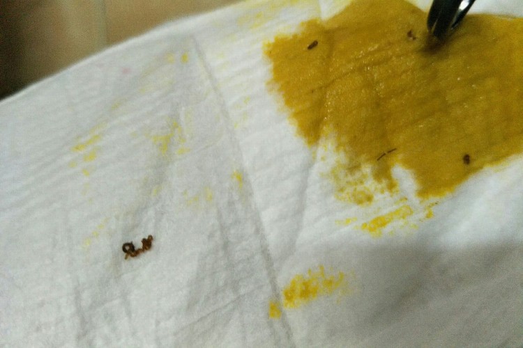 擦大便纸上有黑渣正常现象图