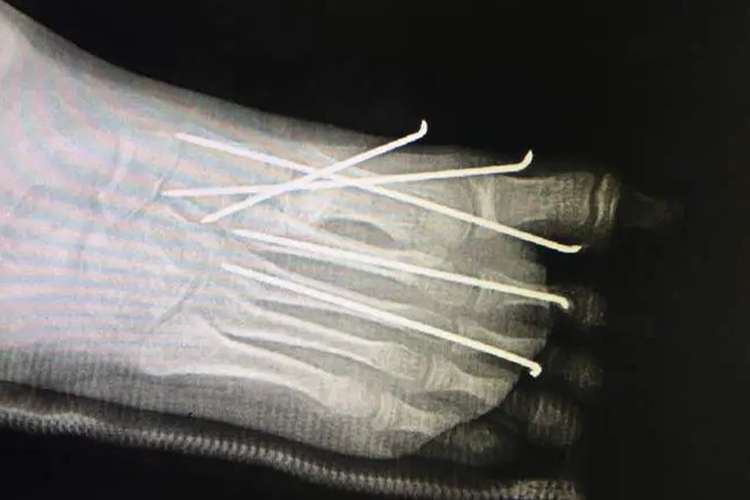 跖骨骨折克氏针固定图