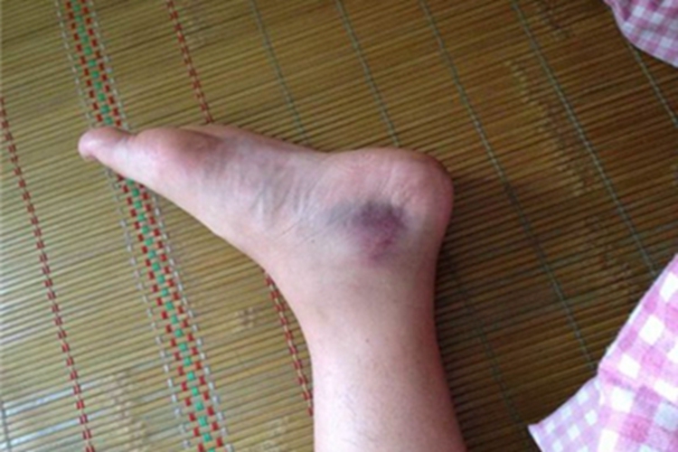 踝扭伤脚踝有青紫色斑块图