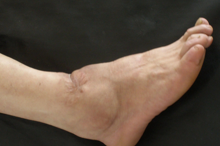 踝部关节炎疼痛肿胀图