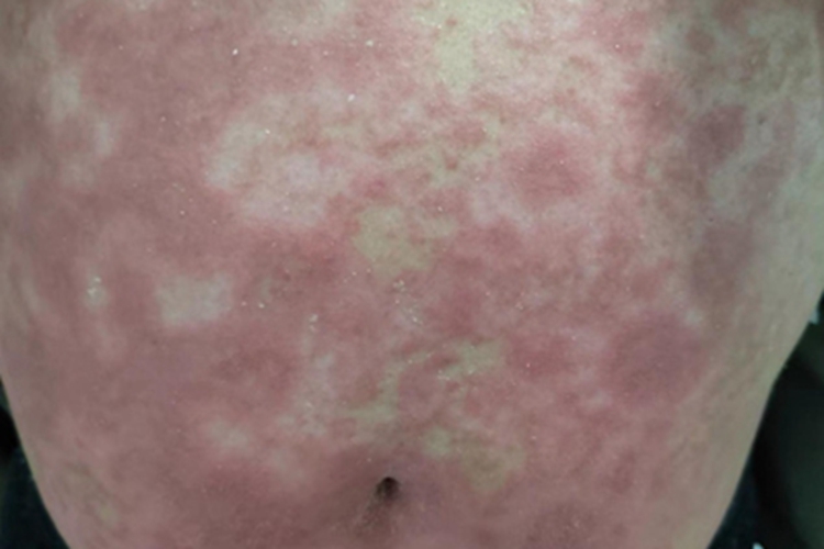 荨麻疹型药疹腹部红斑图 荨麻疹型药疹腹部红斑图