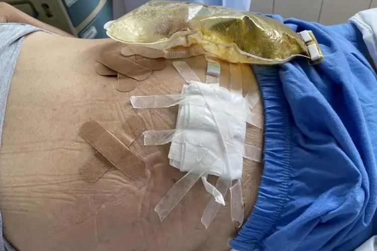 直肠造瘘口排便图