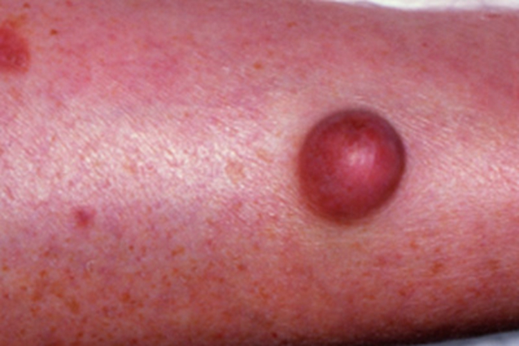 进行性结节性组织细胞瘤小腿瘤图