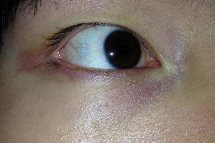 用眼过度眼睛周围一圈发红图