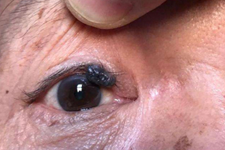 结节型基底细胞瘤眼睑疙瘩图 结节型基底细胞瘤眼睑疙瘩图