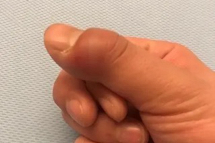 蜂窝织炎手指肿胀发红图 蜂窝织炎手指肿胀发红图