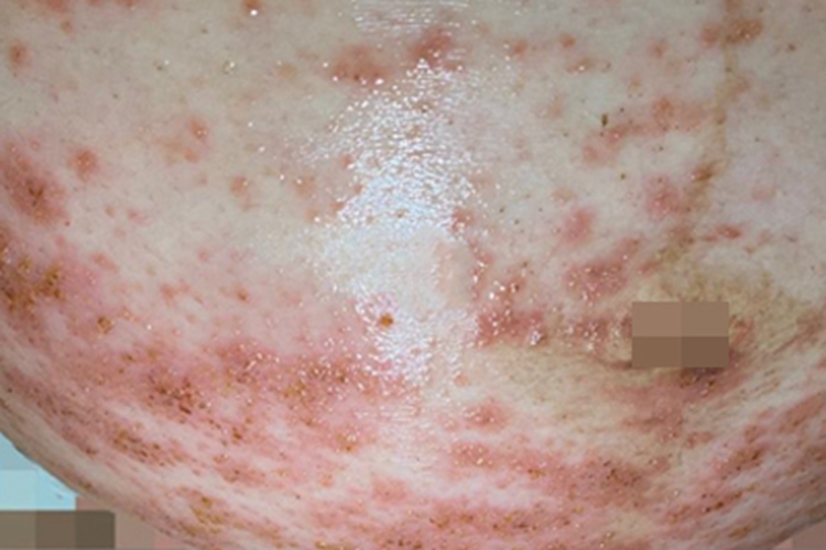 急性湿疹腹部小疙瘩结黄痂图