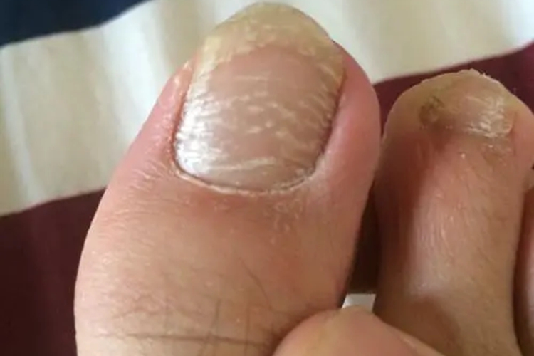 脚指甲被腐蚀有白色浑浊图 脚指甲被腐蚀有白色浑浊图