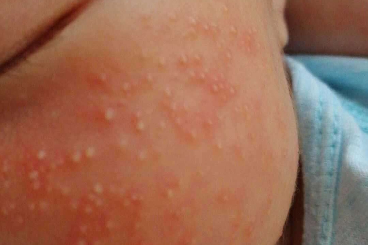 湿热浸淫宝宝热毒疹图