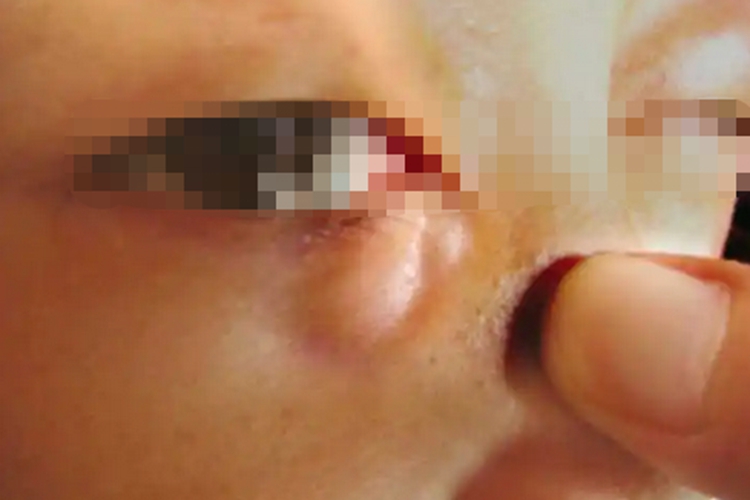 眼囊虫病眼部寄生图 眼囊虫病眼部寄生图