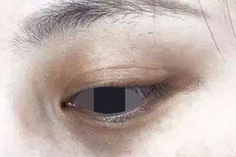眶周色素沉着症黑斑图