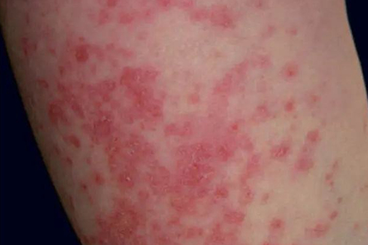 泛发型急性皮肤型红斑狼疮图