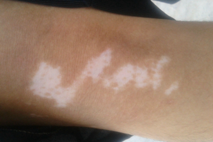 特发性点状色素减退斑胳膊白斑图
