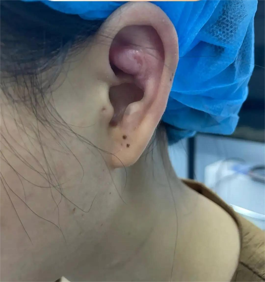 耳甲艇软骨增生图