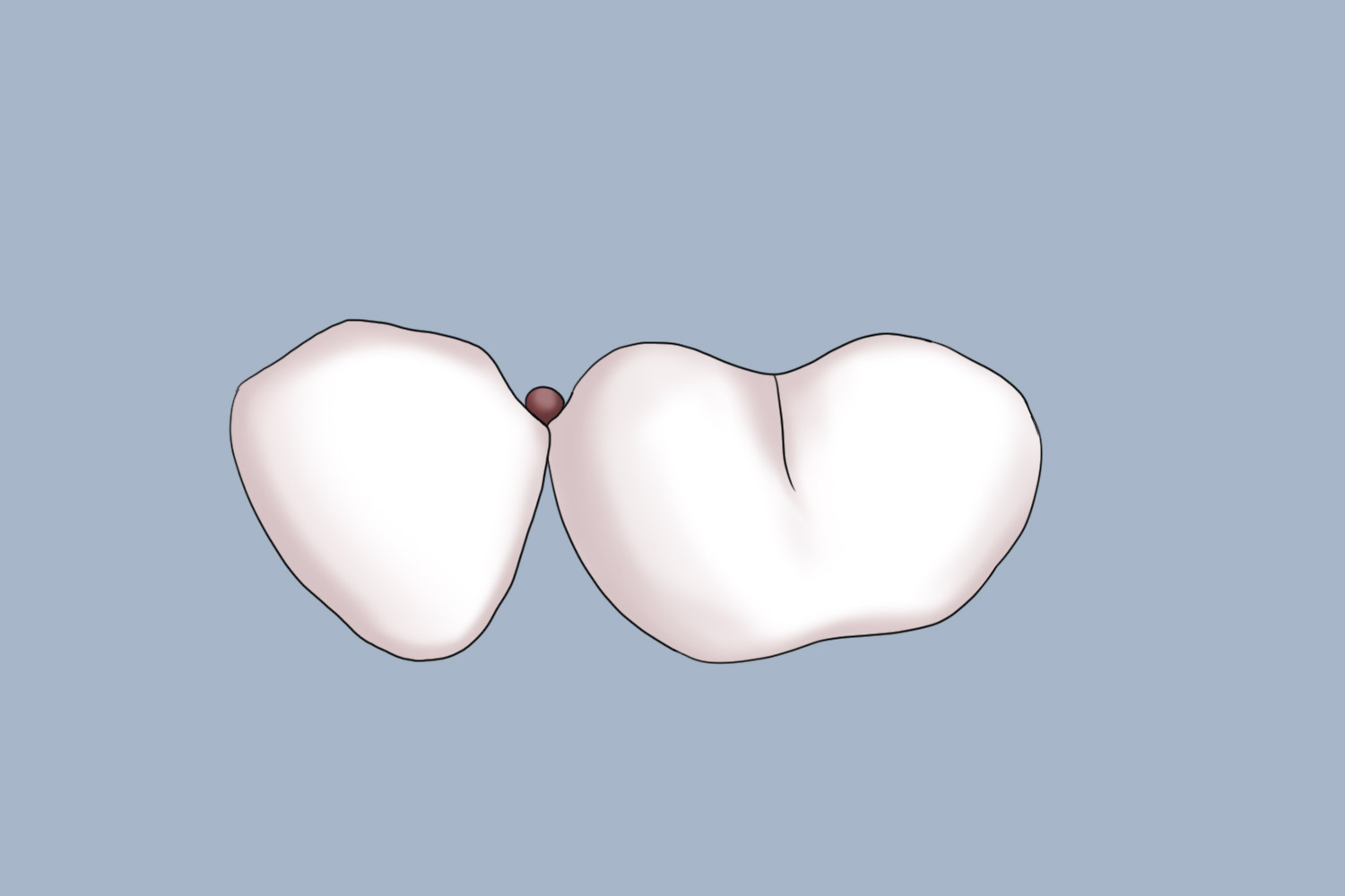 隙卡间隙预备图