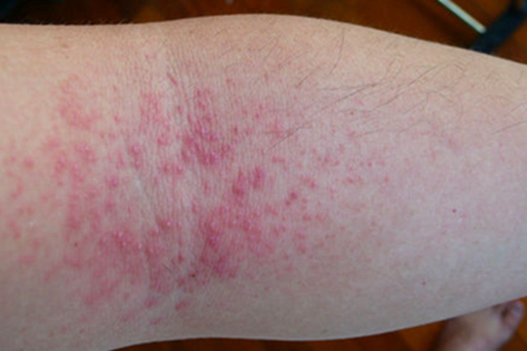 红痱胳膊丘疹图