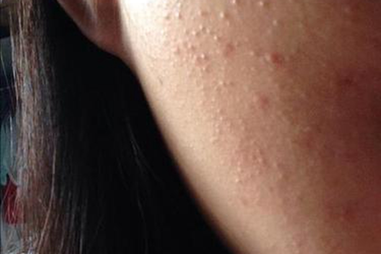 粟丘疹针尖状丘疹图