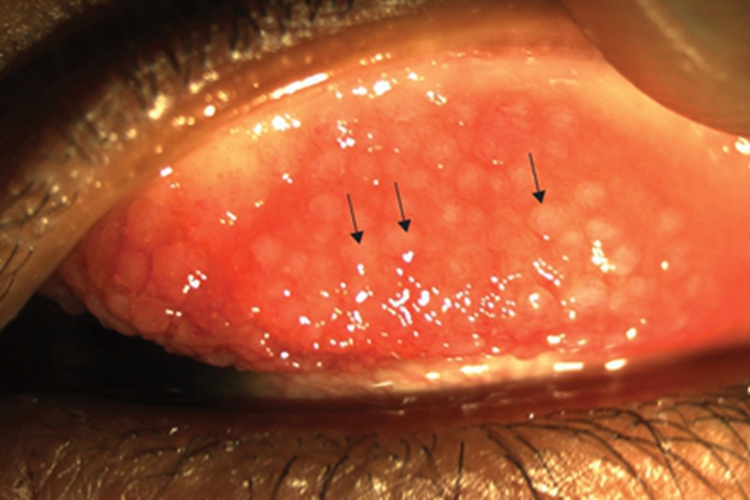 特应性角结膜炎症状图 特应性角结膜炎症状图