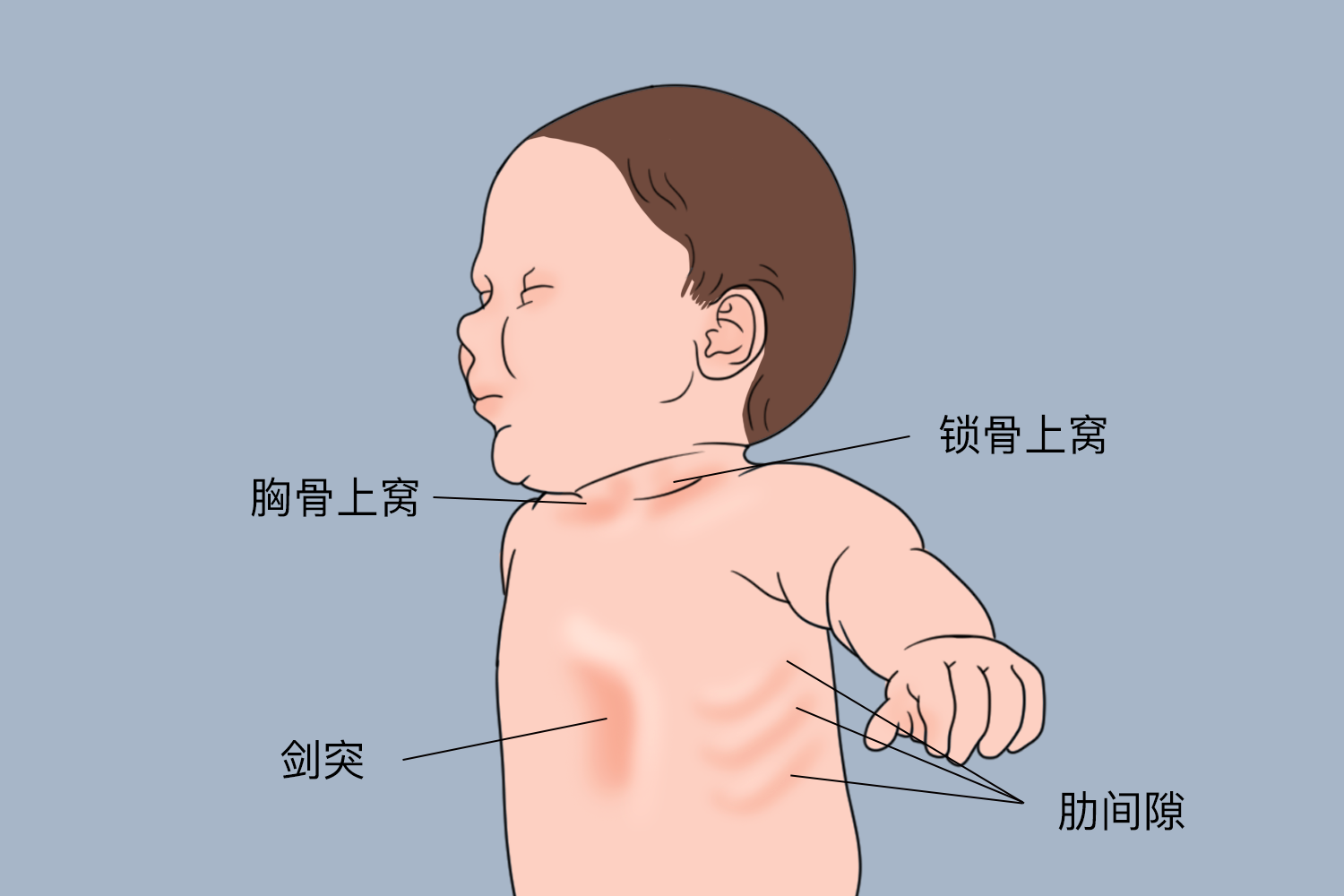 新生儿肺炎三凹征图片图片