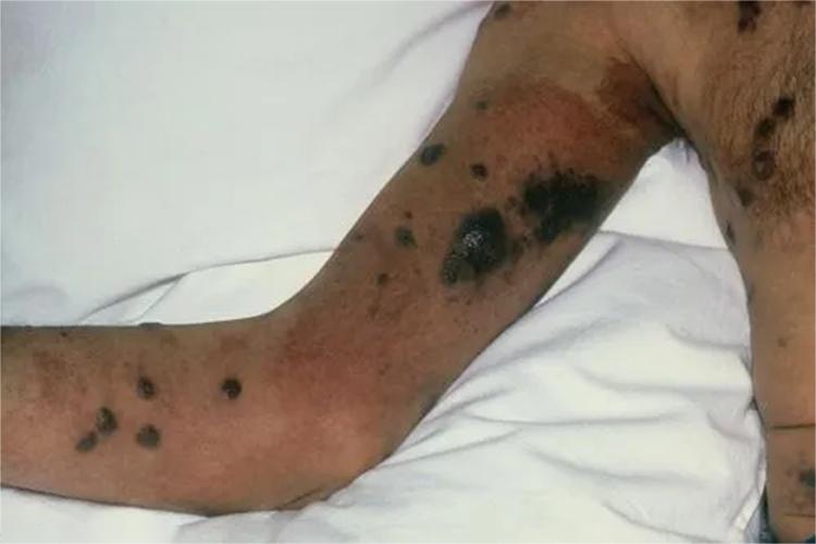 艾滋病皮肤卡波西肉瘤图