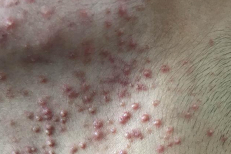 毛囊炎颈部小丘疹图