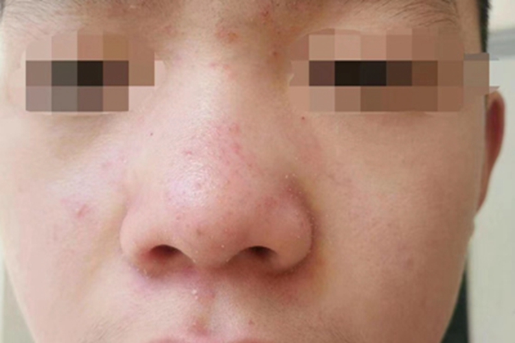 脂溢性皮炎面部小红疙瘩图