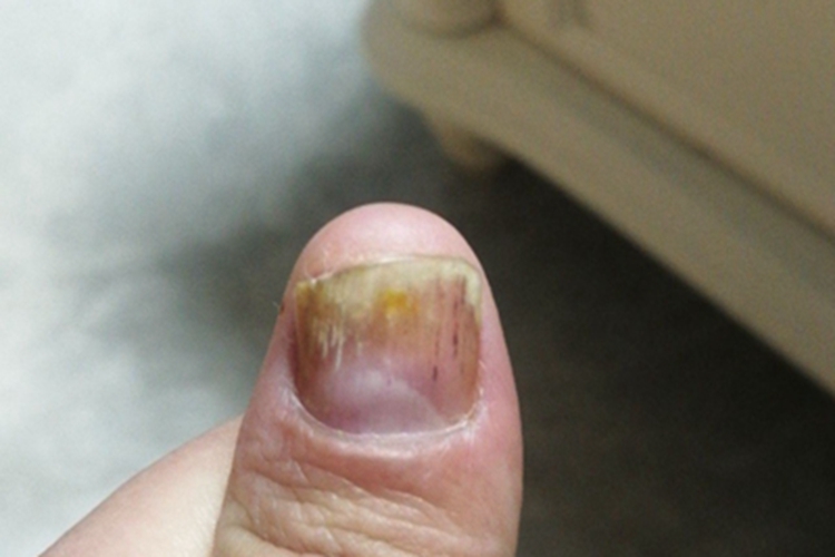 甲分离指甲表面分层变色图