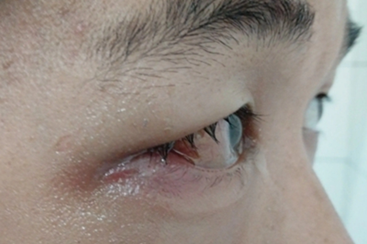 眼眶蜂窝织炎眼角红肿图