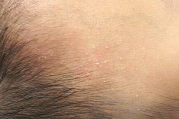 痱子症状图 痱子症状图