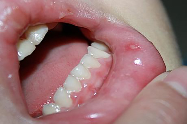 手足口病初期唇部疱疹图病因嘴唇疱疹主要由病毒感染所致.