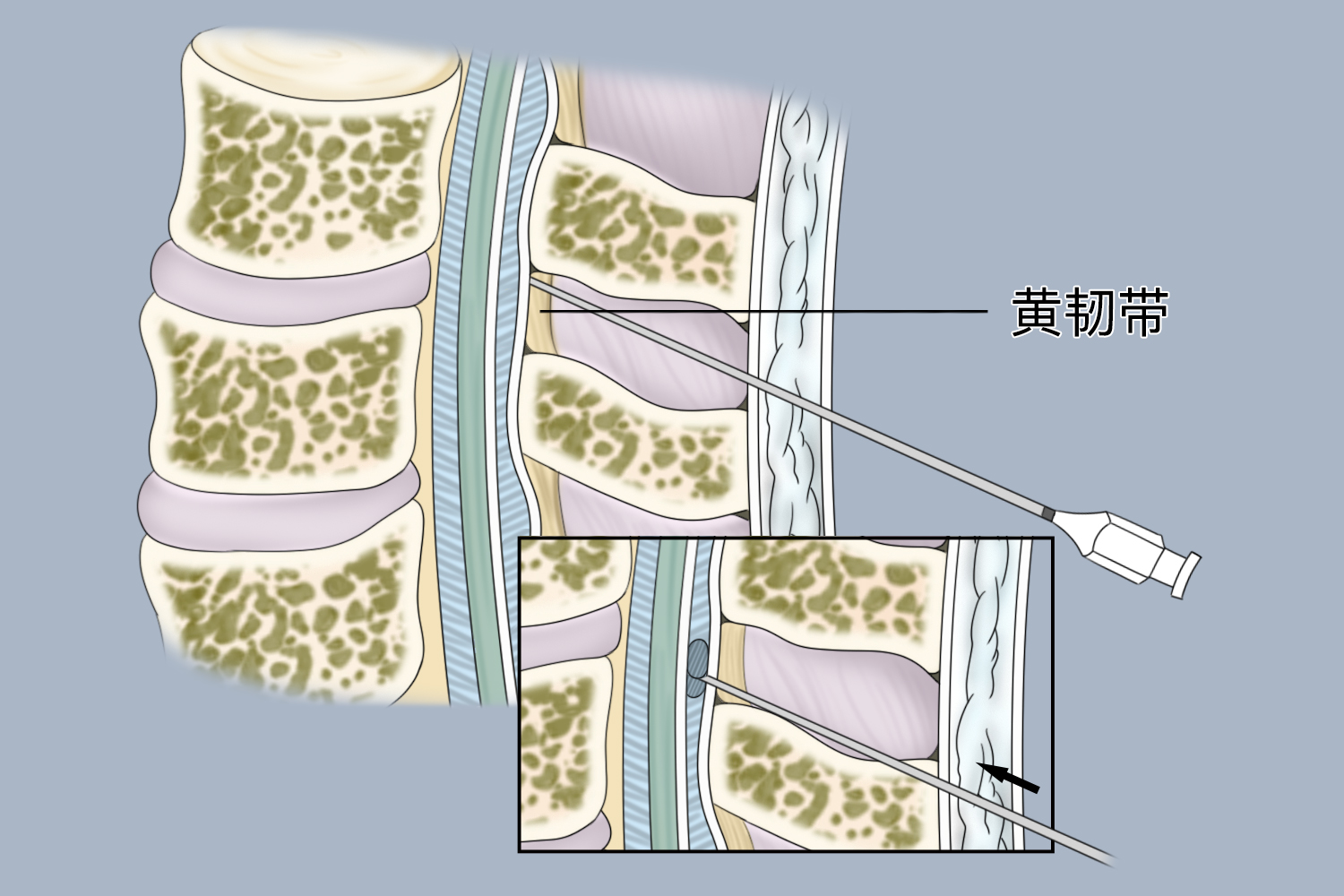 硬膜外穿刺术侧入法图