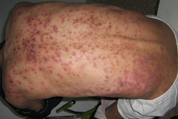 脓毒败血症疹背部血痂图