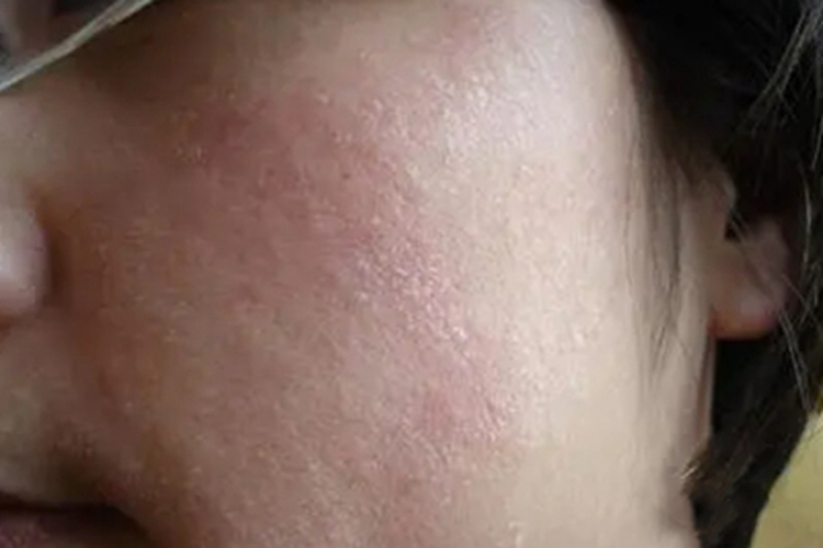 锌缺乏症红斑图 锌缺乏症红斑图