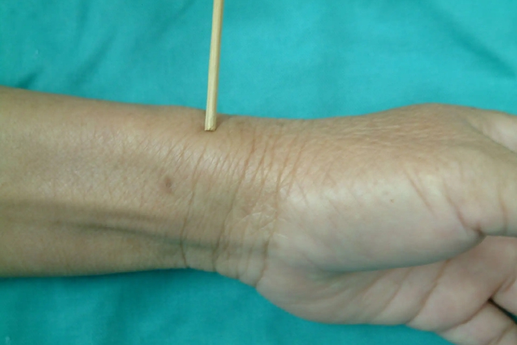 手部桡骨茎突狭窄性腱鞘炎位置图