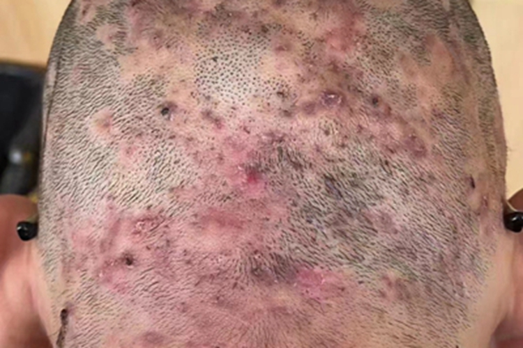 脱发性毛囊炎结痂图