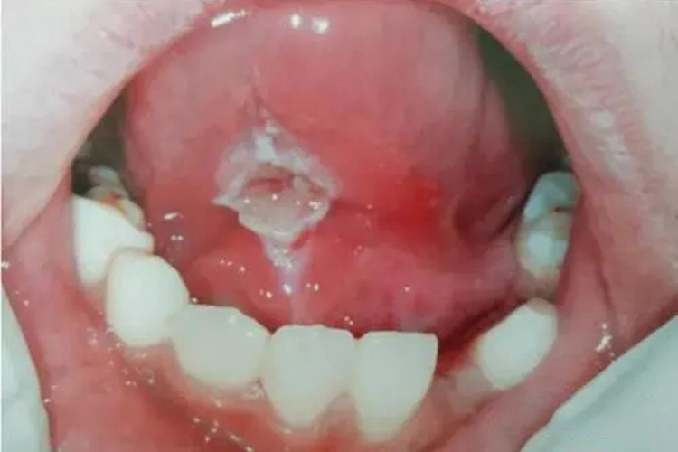 重型阿弗他溃疡图 重型阿弗他溃疡图