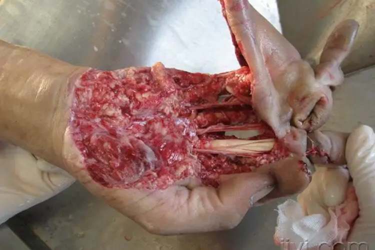 开放性脱套伤图 开放性脱套伤图