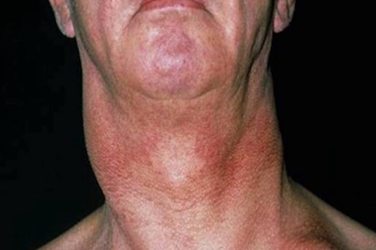 艾滋病急性感染期颈部侧边肿块图